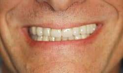 Clinical view of the implant-supported crown makeover.